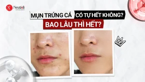 Mụn trứng cá bao lâu thì hết?