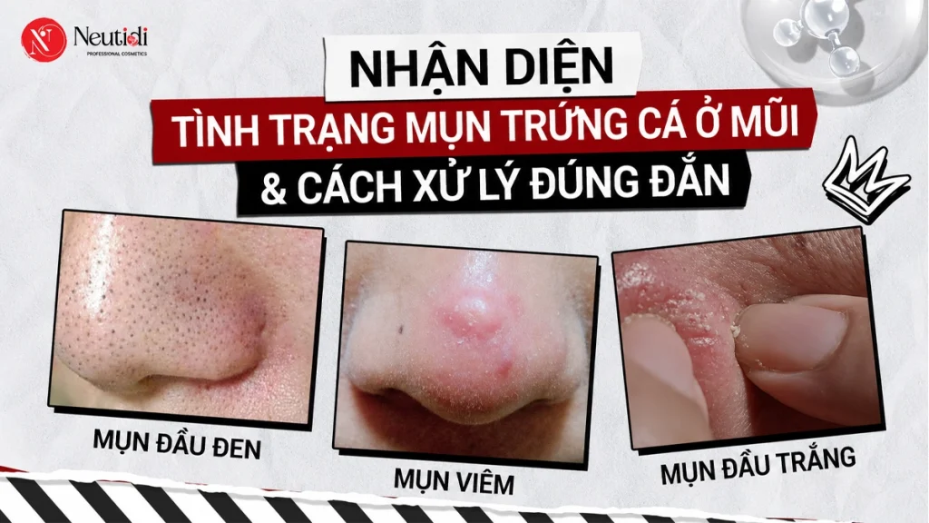 Tìm hiểu và nhận diện mụn trứng cá ở mũi