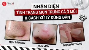 Mụn trứng cá ở cánh mũi, đầu mũi: Nguyên nhân & Cách xử lý theo từng trường hợp 16 Tìm hiểu và nhận diện mụn trứng cá ở mũi