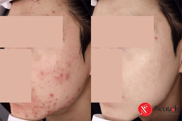 Mụn trứng cá bị viêm trung bình bao lâu thì hết?