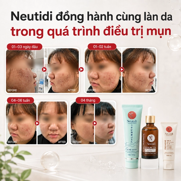 Neutidi đồng hành trong quá trình điều trị mụn trứng cá