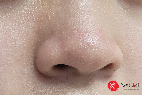 Nguyên nhân gây mụn cám và sợi bã nhờn