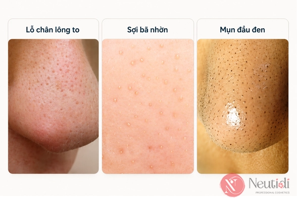 Lỗ chân lông to ở mũi: 7 cách thu nhỏ hiệu quả được nhiều người áp dụng 3 Phân biệt lỗ chân lông to ở mũi với các vấn đề da khác