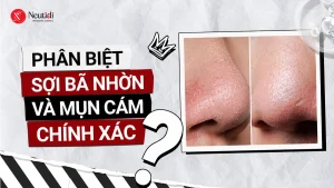 Phân biệt sợi bã nhờn và mụn cám