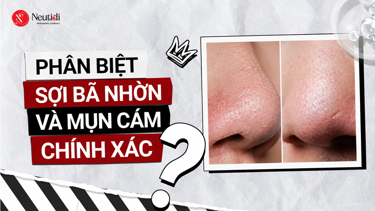 Mụn cám và sợi bã nhờn: Cách phân biệt và xử lý triệt để 18 Phân biệt sợi bã nhờn và mụn cám