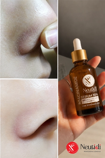 TOP 6 sản phẩm hỗ trợ giảm sợi bã nhờn hiệu quả 2026 7 Serum giảm sợi bã nhờn hiệu quả 2026