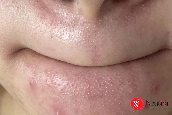 Sợi bã nhờn là gì