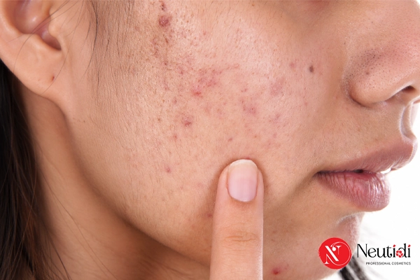 Có nên nặn mụn trứng cá không? Loại nào có thể nặn? 2 Vì sao không nên nặn mụn trứng cá?