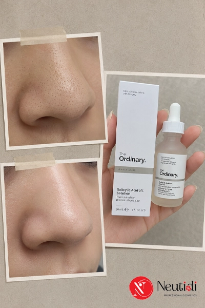 TOP 6 sản phẩm hỗ trợ giảm sợi bã nhờn hiệu quả 2026 3 The Ordinary Salicylic Acid 2% Solution giảm sợi bã nhờn và mụn đầu đen