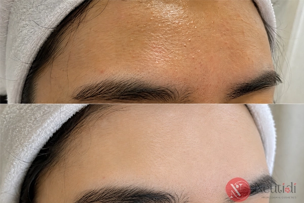 Cách thu nhỏ lỗ chân lông ở trán và cằm hiệu quả