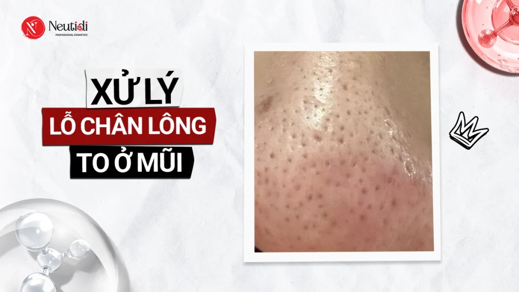 Lỗ chân lông to ở mũi: 7 cách thu nhỏ hiệu quả được nhiều người áp dụng 1 Cách trị lỗ chân lông to ở mũi