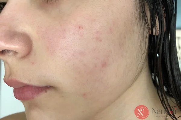 10 cách trị thâm mụn cấp tốc trong 1 tuần bạn nên thử 4 Sử dụng các hoạt chất trị thâm mụn