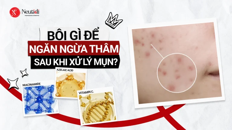Sau khi nặn mụn nên bôi gì để không bị thâm