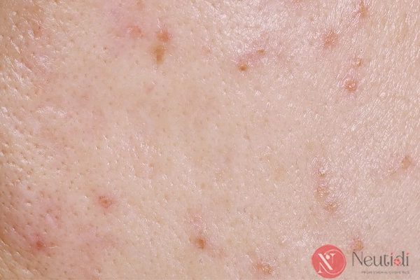 Nhận biết các vết thâm do mụn gây ra