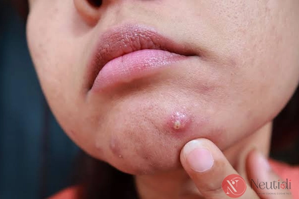 Nguyên nhân vì sao tuổi trung niên vẫn nổi mụn