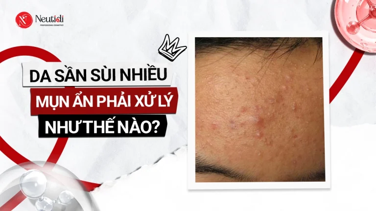 Cách trị da sần sùi nhiều mụn ẩn hiệu quả