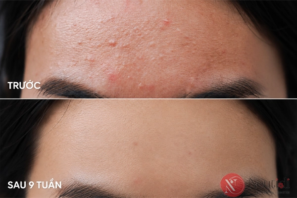 BHA trị mụn ẩn: cách dùng đúng và khi nào không nên 6 Dùng BHA trị mụn ẩn trong bao lâu?