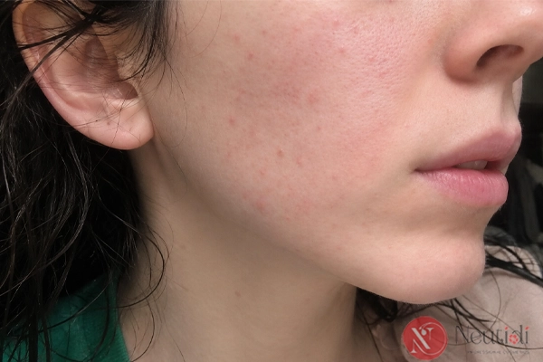 BHA trị mụn ẩn: cách dùng đúng và khi nào không nên 3 Trường hợp da mụn ẩn nhưng không nên dùng BHA