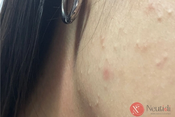 6 cách triệt nhân mụn ẩn, làm mịn da sần sùi hiệu quả sau 8 tuần 6 Chỉ lấy nhân mụn ẩn khi đã gom cồi mụn