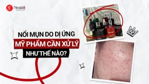 Mụn do dị ứng mỹ phẩm