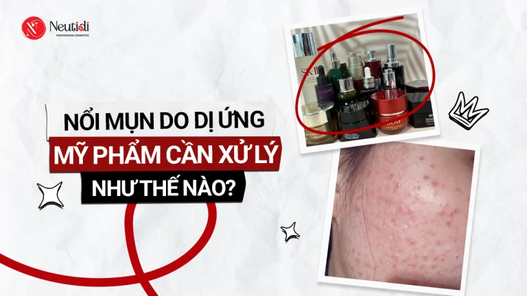Mụn do dị ứng mỹ phẩm