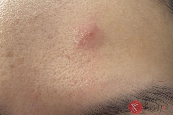 Vì sao vết thâm mụn mãi không hết, bôi đủ thứ vẫn không cải thiện? 3 Mụn tái phát ở vị trí cũ