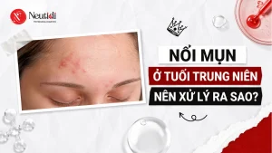 Bị nổi mụn ở tuổi trung niên nên xử lý sao cho đúng? 16 Nổi mụn trứng cá ở tuổi trung niên, tuổi trưởng thành
