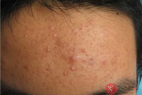 Nội tiết gây nổi mụn trứng cá ở người trưởng thành