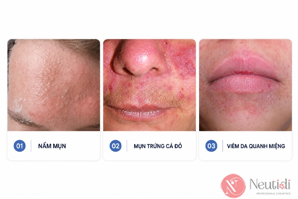Phân biệt mụn trứng cá tuổi trung niên với một số vấn đề da tương tự