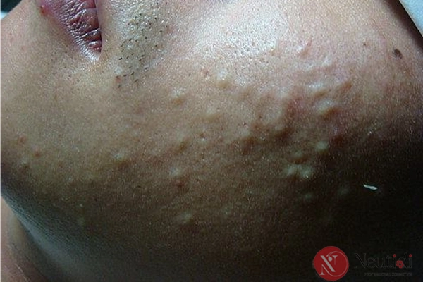 6 cách triệt nhân mụn ẩn, làm mịn da sần sùi hiệu quả sau 8 tuần 4 Sử dụng retinoid trị mụn ẩn, làm mịn da sần sùi