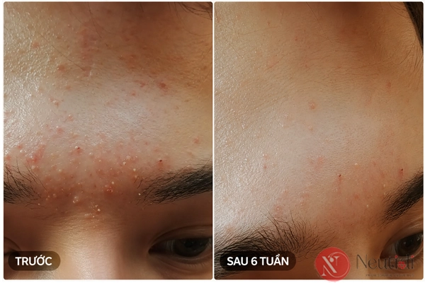 Top 11 sữa rửa mặt trị mụn ẩn được đánh giá cao 2026 5 Trải nghiệm sữa rửa mặt Neutidi trong việc hỗ trợ giảm mụn ẩn