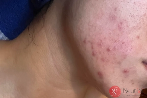 Tránh dùng mẹo dân gian trị thâm sau nặn mụn lên vết thương hở
