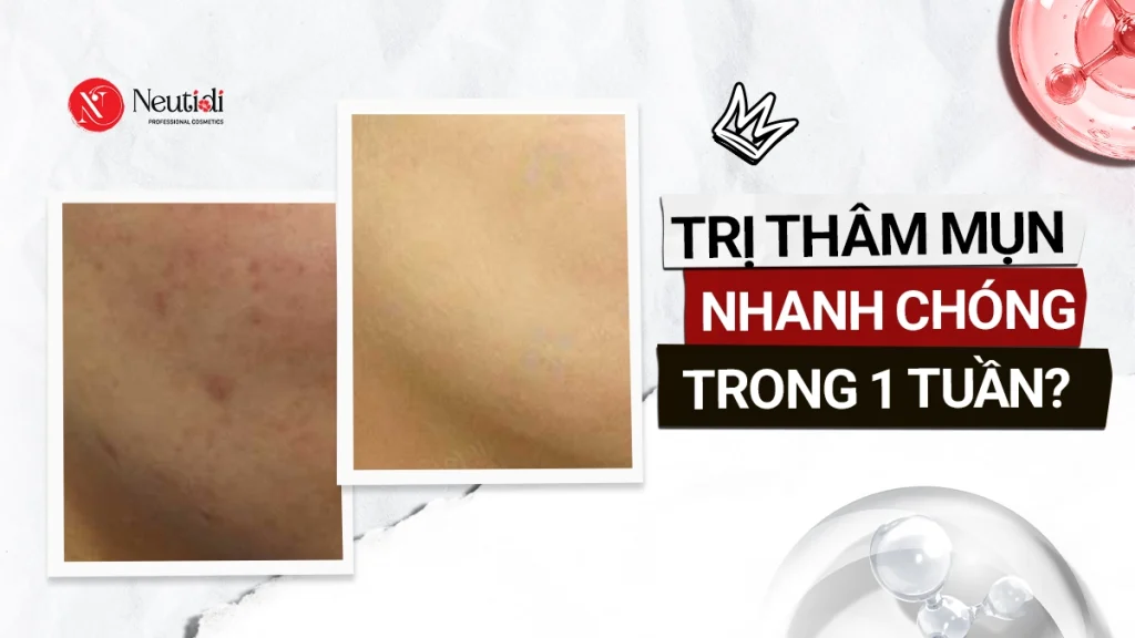 10 cách trị thâm mụn cấp tốc trong 1 tuần bạn nên thử 1 Cách trị thâm mụn nhanh nhất trong vòng 1 tuần