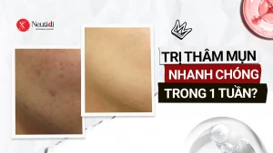 10 cách trị thâm mụn cấp tốc trong 1 tuần bạn nên thử 16 Cách trị thâm mụn nhanh nhất trong vòng 1 tuần
