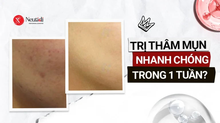 Cách trị thâm mụn nhanh nhất trong vòng 1 tuần