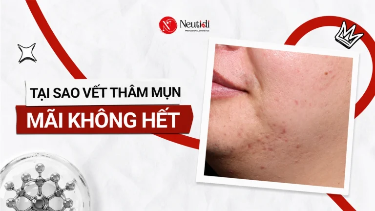 Vết thâm mụn mãi không hết