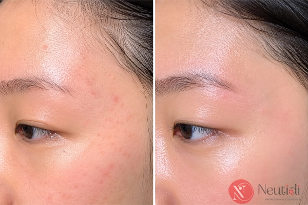 Sử dụng vitamin C để làm giảm thâm mụn