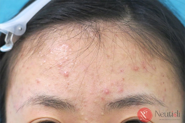 Nhận diện 6 loại mụn thường gặp ở tuổi dậy thì & Cách xử lý 2 Các loại mụn trứng cá hay gặp ở tuổi dậy thì