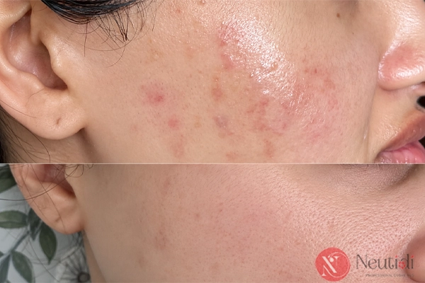 Dùng niacinamide sai cách khiến hoạt chất khó phát huy hiệu quả