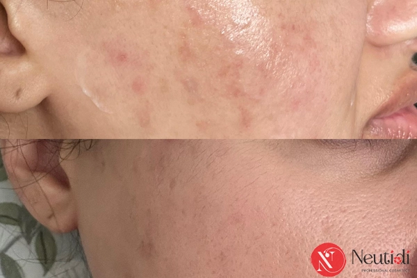 Da treatment có nên dùng niacinamide
