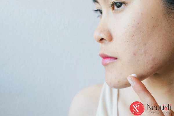 Dấu hiệu cho thấy da sau treatment nên dùng niacinamide