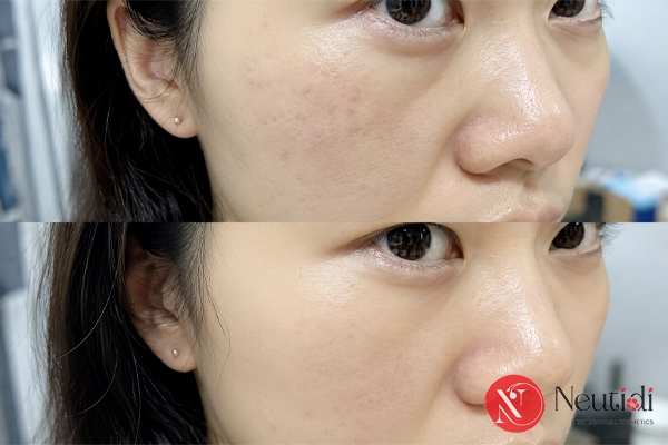 Da mặt không đều màu phải làm sao? Cách chăm sóc đúng hướng 7 Hoạt chất xử lý làm đều màu da