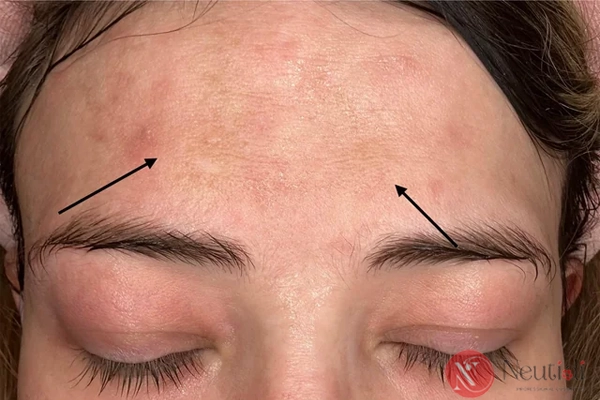 Dùng niacinamide không kết hợp chống nắng - nguyên nhân khiến hiệu quả giảm sút