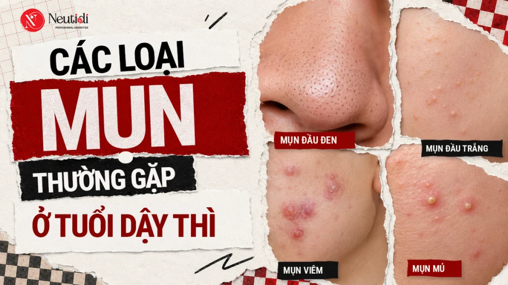 Nhận diện 6 loại mụn thường gặp ở tuổi dậy thì & Cách xử lý 1 Các loại mụn thường gặp ở tuổi dậy thì