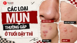 Các loại mụn thường gặp ở tuổi dậy thì