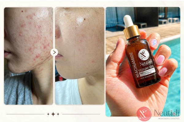 Serum Neutidi niacinamide 10% - giảm mụn cho da nhạy cảm