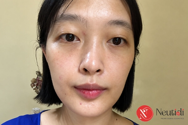 Da mặt không đều màu phải làm sao? Cách chăm sóc đúng hướng 2 Những nguyên nhân khiến da mặt không đều màu