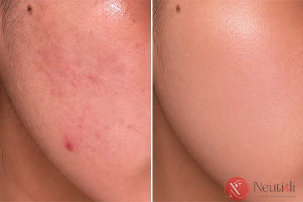 Thế nào là serum trị mụn tốt cho da nhạy cảm
