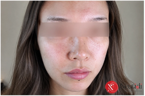 Da mặt không đều màu phải làm sao? Cách chăm sóc đúng hướng 3 Skincare sai cách có thể khiến da thâm, tăng sắc tố