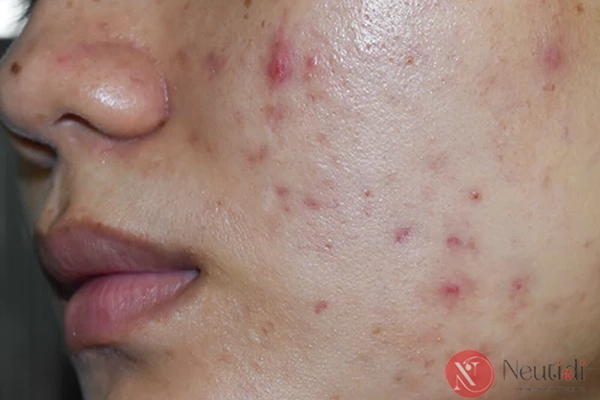 Thâm mụn cần xử lý như thế nào